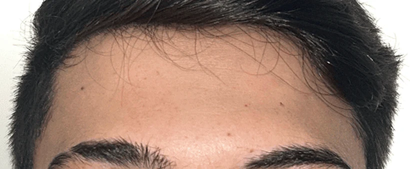 Depois: expressão suavizada