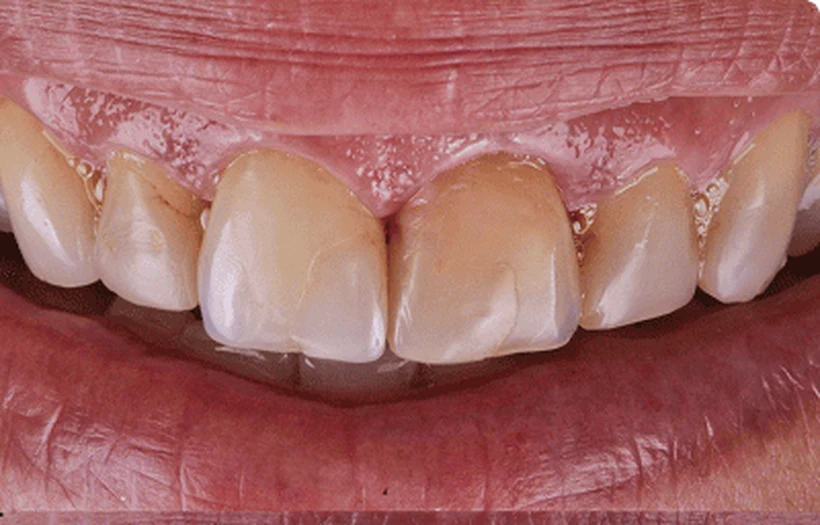 Antes: dentes manchados e desgastados