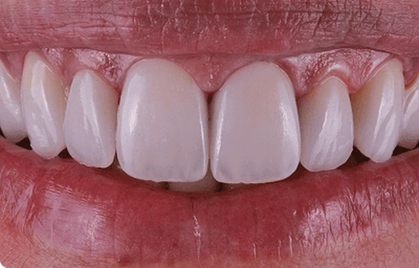 Depois: sorriso harmonizado com facetas