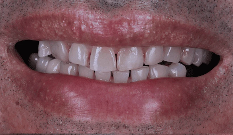 Antes: dentes desalinhados