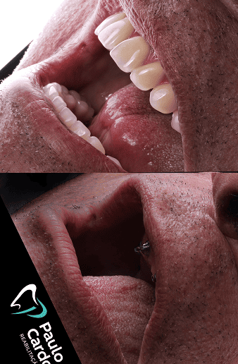 foto protese Dr Paulo Cardoso Reabilitação Oral