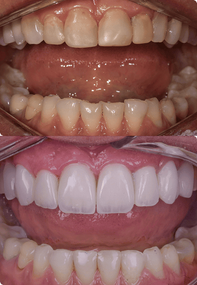 foto protese Dr Paulo Cardoso Reabilitação Oral