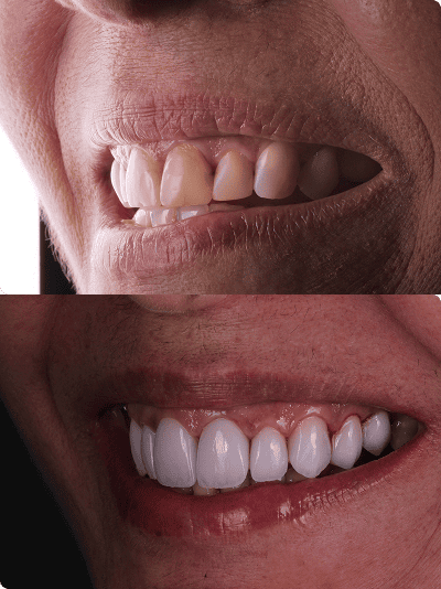 foto protese Dr Paulo Cardoso Reabilitação Oral