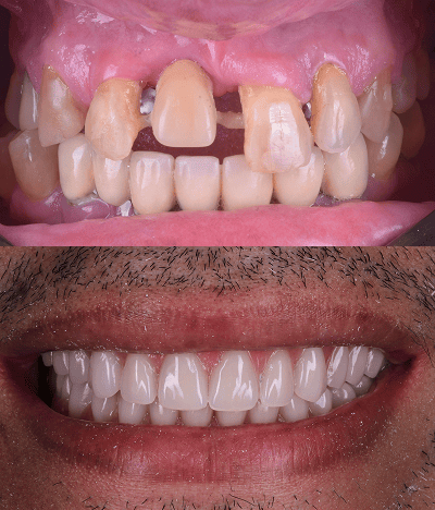 foto protese Dr Paulo Cardoso Reabilitação Oral