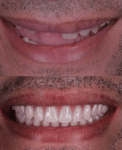 foto protese Dr Paulo Cardoso Reabilitação Oral