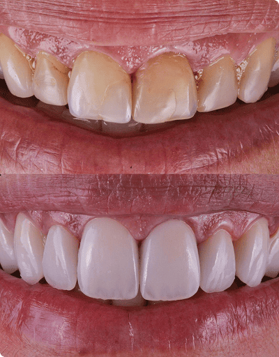 foto protese Dr Paulo Cardoso Reabilitação Oral