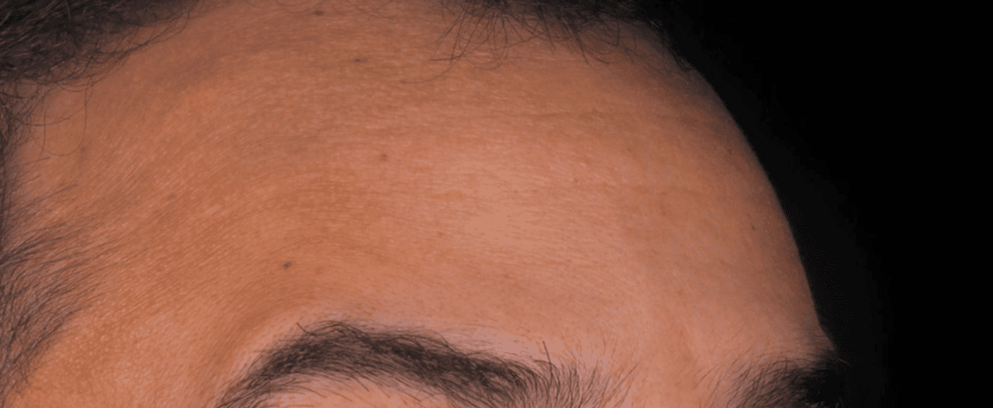 foto protese Dr Paulo Cardoso Reabilitação Oral