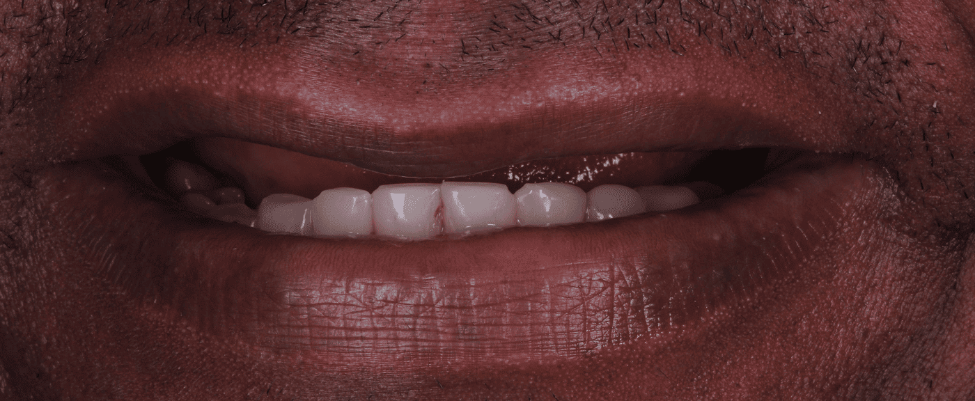 foto protese Dr Paulo Cardoso Reabilitação Oral