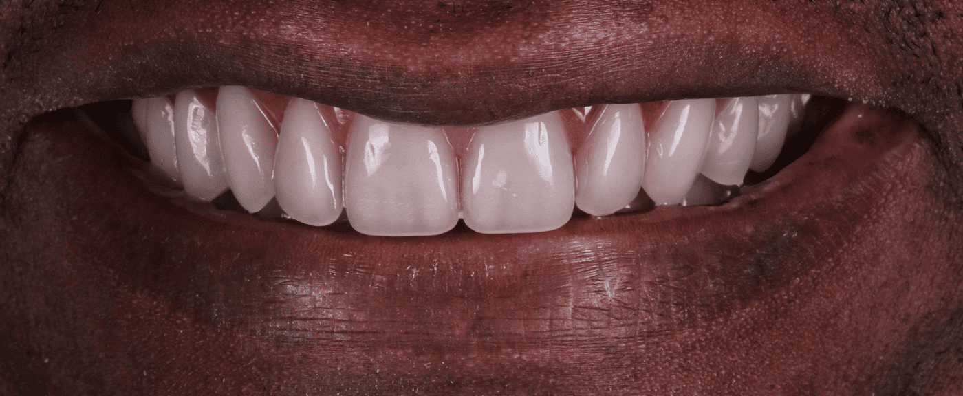 foto protese Dr Paulo Cardoso Reabilitação Oral