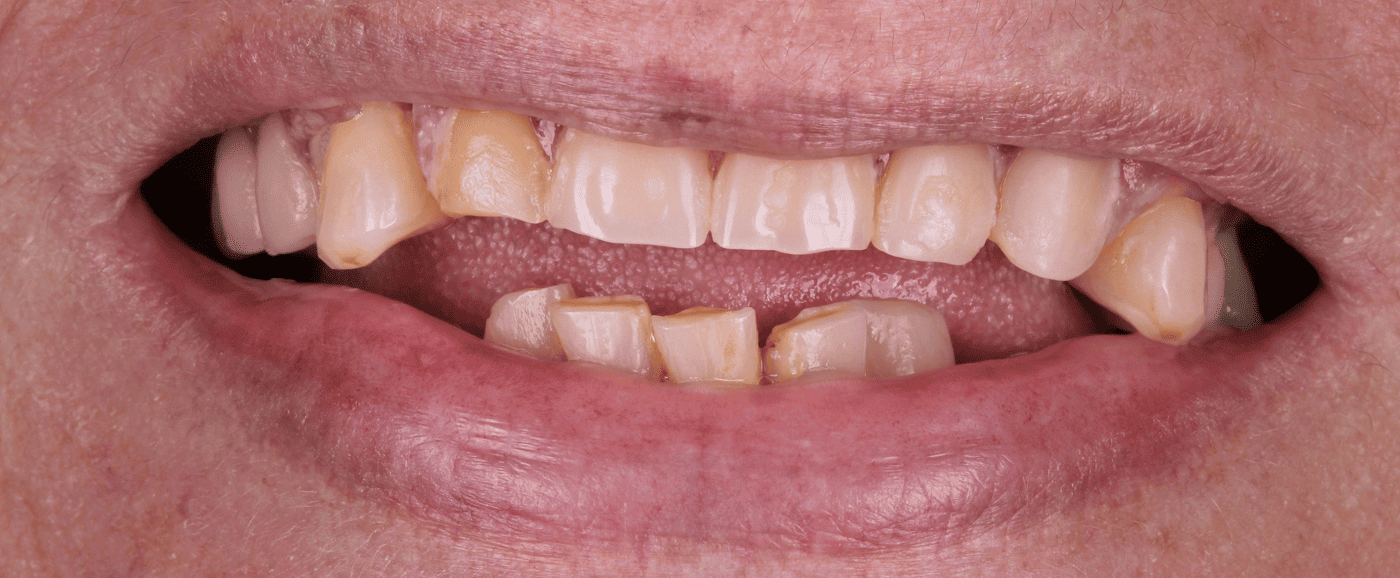 foto protese Dr Paulo Cardoso Reabilitação Oral