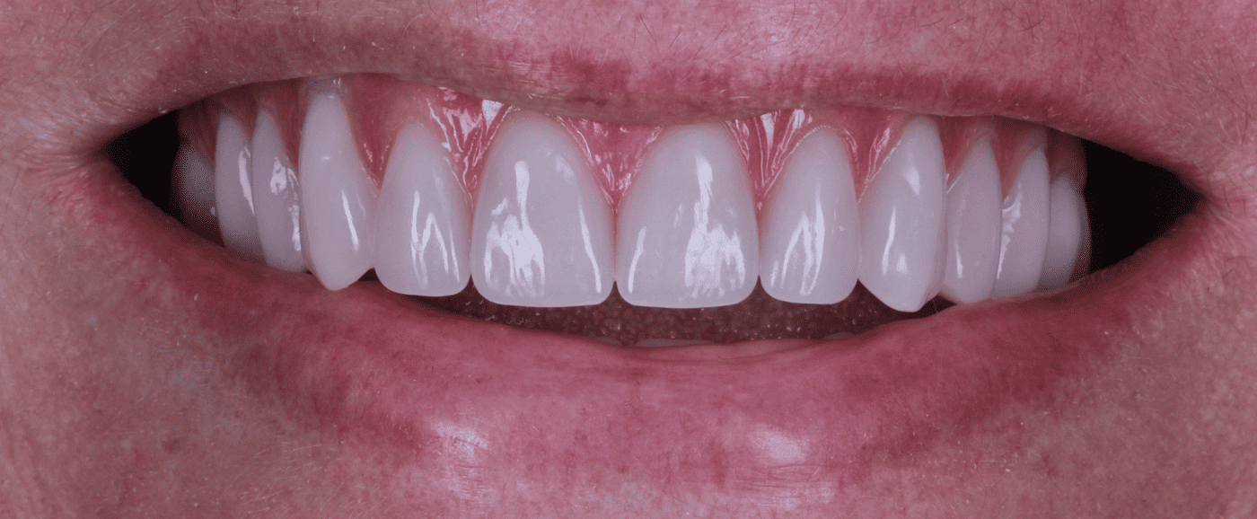 foto protese Dr Paulo Cardoso Reabilitação Oral