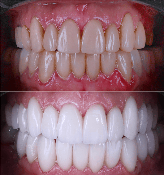 foto protese Dr Paulo Cardoso Reabilitação Oral