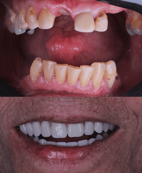 foto protese Dr Paulo Cardoso Reabilitação Oral