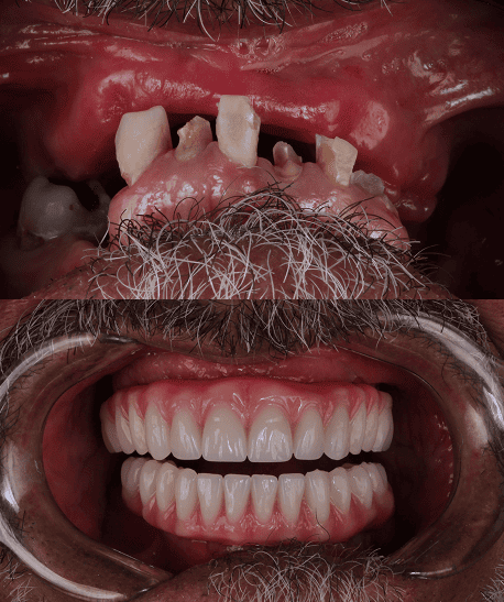 foto protese Dr Paulo Cardoso Reabilitação Oral