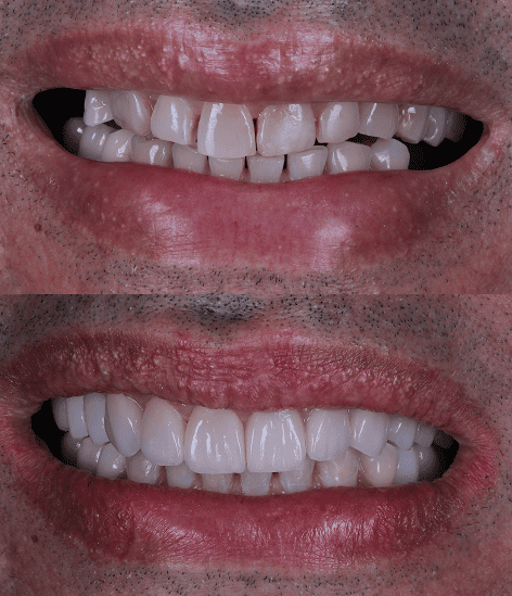 foto protese Dr Paulo Cardoso Reabilitação Oral